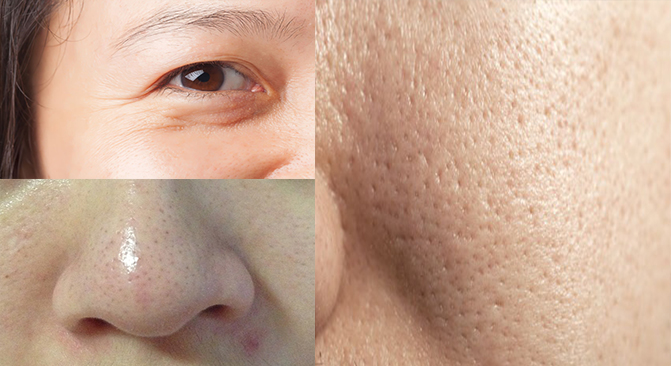 Hình ảnh da nhờn lỗ chân lông to